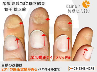 深爪は人により症状は異なります 3分でわかる 爪のトラブルの理由とその解決方法