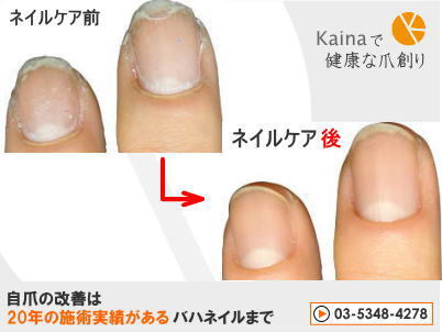 爪の病気 ぼこぼこ ガタガタ変形の原因 爪のお悩み解決 自爪を強く綺麗にするならkaina